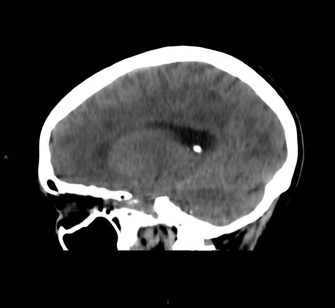 File:Cerebral amyloid angiopathy-associated lobar intracerebral hemorrhage (Radiopaedia 58566-65730 C 32).jpg