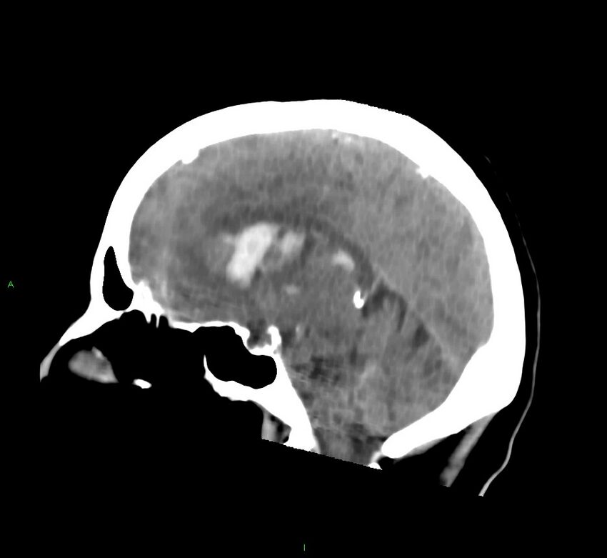 Cerebral amyloid angiopathy-associated lobar intracerebral hemorrhage (Radiopaedia 58752-65973 C 27).jpg