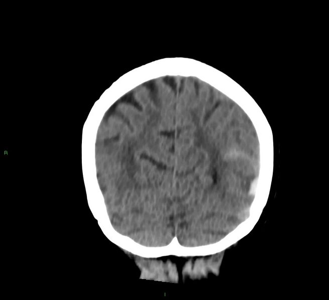 File:Cerebral amyloid angiopathy-associated lobar intracerebral hemorrhage (Radiopaedia 58757-65978 Coronal non-contrast 18).jpg