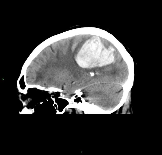 File:Cerebral amyloid angiopathy-associated lobar intracerebral hemorrhage (Radiopaedia 59356-66716 C 21).jpg