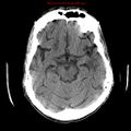 Cerebral and orbital tuberculomas (Radiopaedia 13308-13310 Axial non-contrast 30).jpg