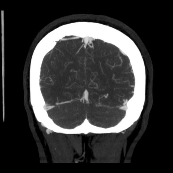 File:Cerebral arteriovenous malformation (Radiopaedia 43729-47189 C 40).jpg
