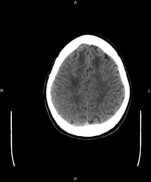 File:Cerebral autosomal dominant arteriopathy with subcortical infarcts and leukoencephalopathy (CADASIL) (Radiopaedia 86108-102051 Axial non-contrast 86).jpg
