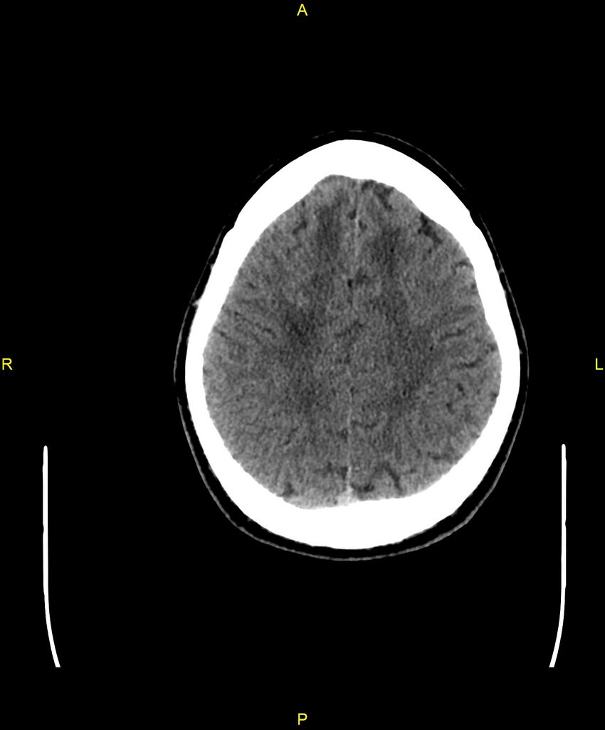 Cerebral autosomal dominant arteriopathy with subcortical infarcts and leukoencephalopathy (CADASIL) (Radiopaedia 86108-102051 Axial non-contrast 86).jpg