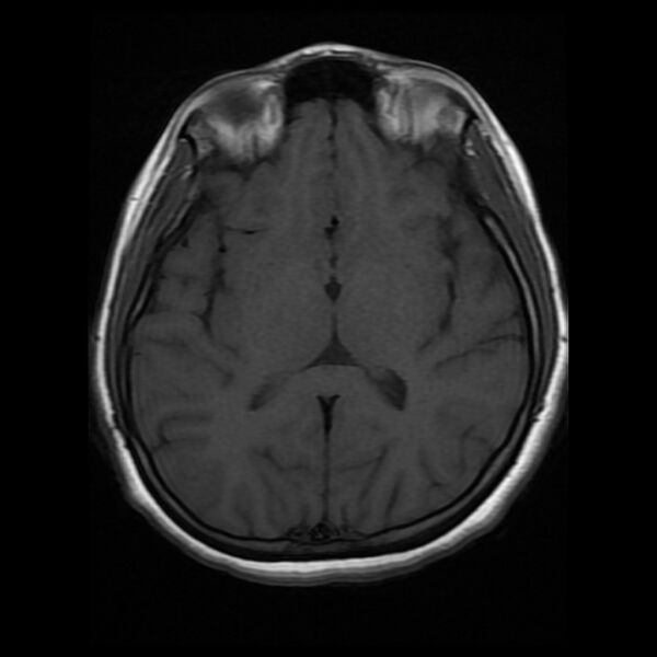 File:Cerebral cavernous malformation (Radiopaedia 44301-47942 Axial T1 11).jpg