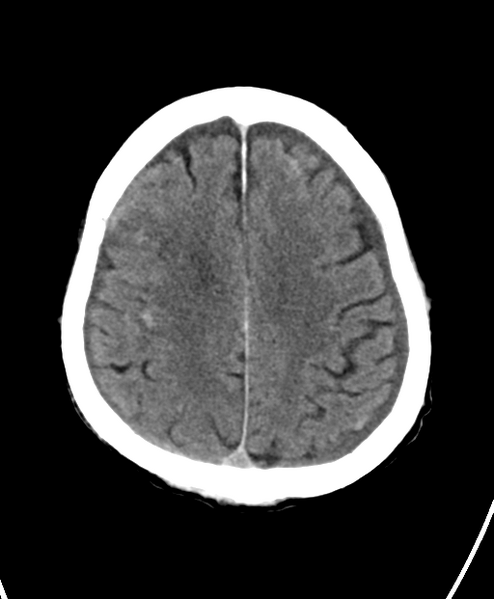 File:Cerebral contusions, subarachnoid hemorrhage and subdural hygromas (Radiopaedia 55399-61828 Axial non-contrast 20).png