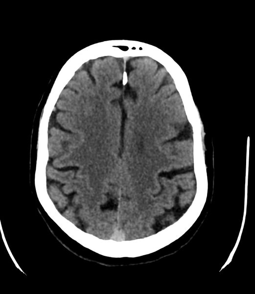 File:Cerebral dural venous sinus thrombosis (Radiopaedia 86514-102575 Axial non-contrast 31).jpg