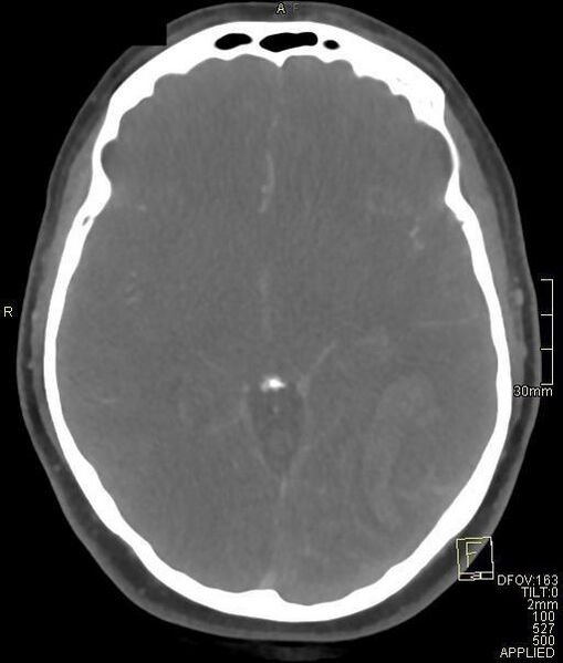 File:Cerebral venous sinus thrombosis (Radiopaedia 91329-108965 Axial venogram 39).jpg