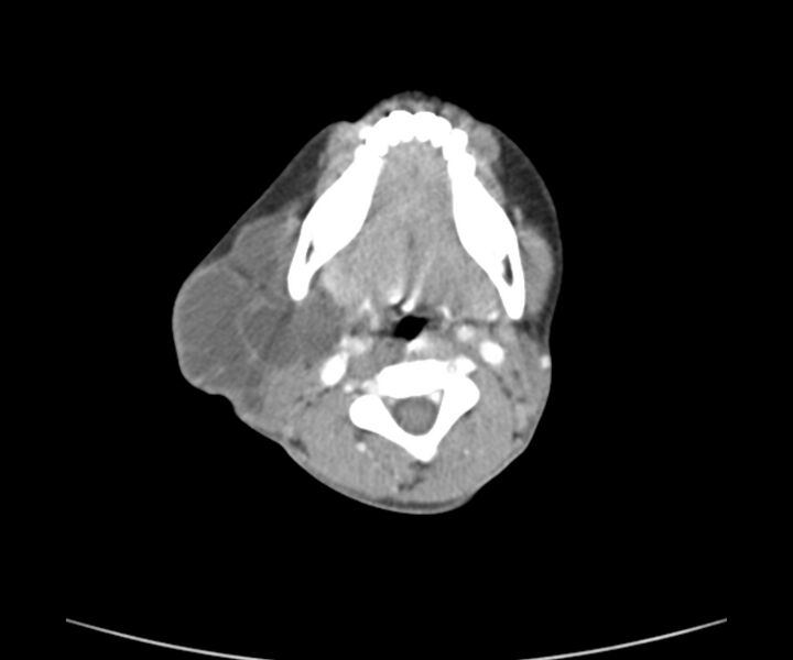 File:Cervical cystic lymphangioma (Radiopaedia 63655-72332 Axial + contrast 13).jpg