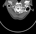 Cervical dural CSF leak on MRI and CT treated by blood patch (Radiopaedia 49748-54996 B 8).png