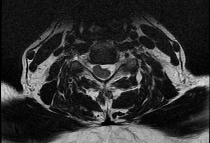 File:Cervical schwannoma (Radiopaedia 72399-82934 Axial T2 14).jpg