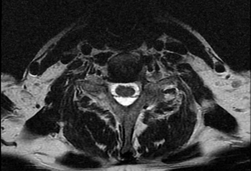File:Cervical schwannoma (Radiopaedia 72399-82934 Axial T2 19).jpg