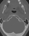 Cervical spine ACDF loosening (Radiopaedia 48998-54071 Axial bone window 10).png