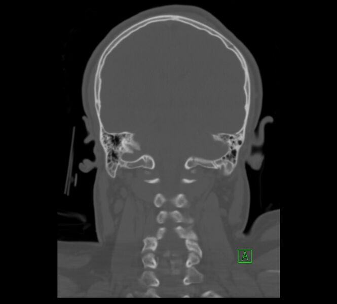 File:Cervical spine fracture - hyperflexion injury (Radiopaedia 66184-75364 Coronal bone window 10).jpg