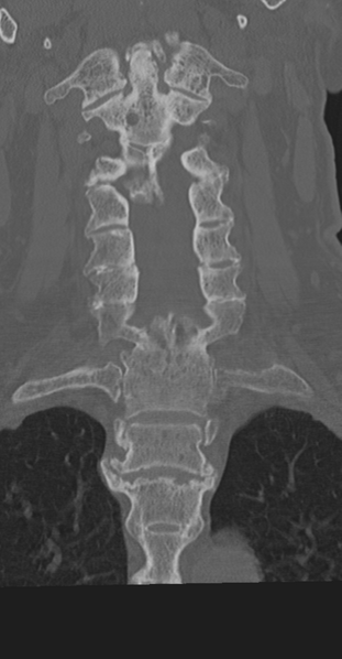 File:Cervical spine fracture in the setting of ankylosis (Radiopaedia 37038-38715 Coronal bone window 34).png