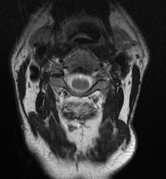 File:Cervical spondylodiscitis (Radiopaedia 81362-95110 Axial T2 2).jpg