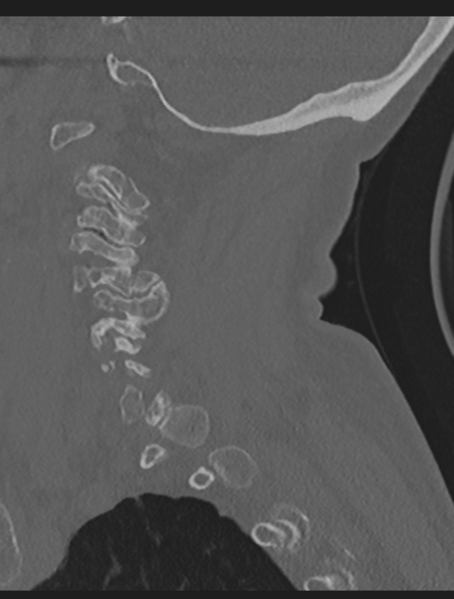 File:Cervical spondylolysis (Radiopaedia 49616-54811 Sagittal bone window 19).png