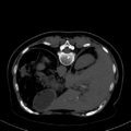 Cholecystitis - CT IVC obstructive choledocholitiasis (Radiopaedia 43966-47479 Axial Biliscopin 34).png