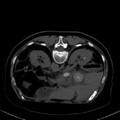 Cholecystitis - CT IVC obstructive choledocholitiasis (Radiopaedia 43966-47479 Axial Biliscopin 44).png