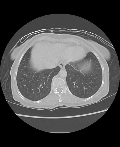 File:Chondrosarcoma (Radiopaedia 79427-92532 Axial lung window 46).jpg