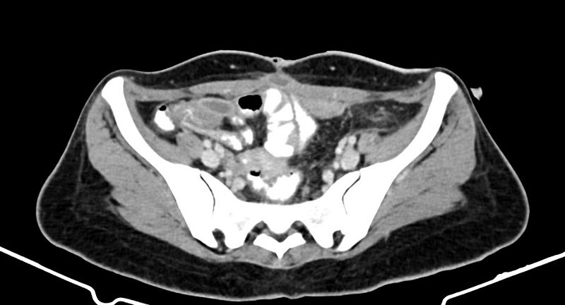 File:Choriocarcinoma liver metastases (Radiopaedia 74768-85766 A 162).jpg