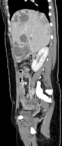 File:Choriocarcinoma liver metastases (Radiopaedia 74768-85766 C 118).jpg