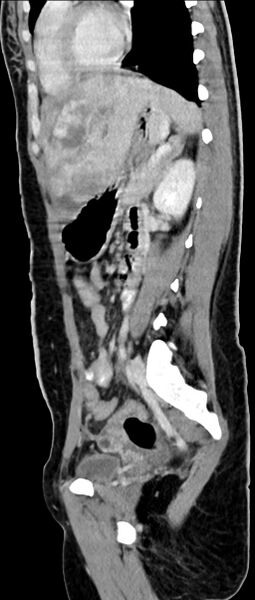 File:Choriocarcinoma liver metastases (Radiopaedia 74768-85766 C 81).jpg