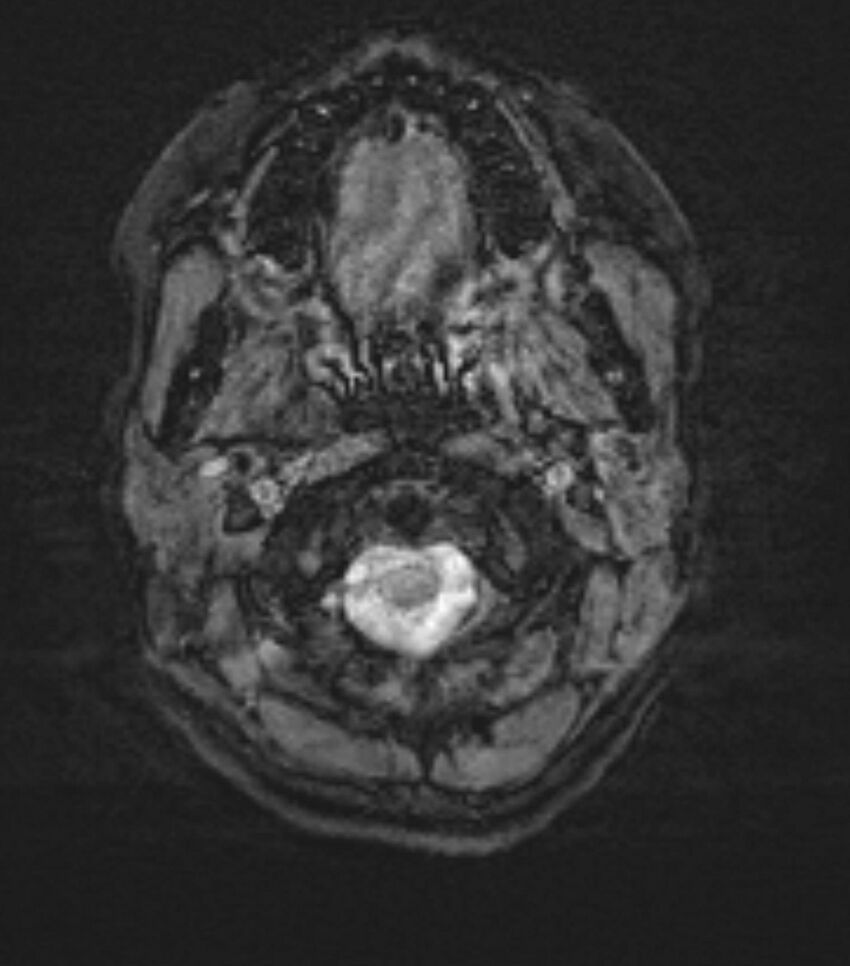 Choroid plexus carcinoma (Radiopaedia 91013-108553 Axial SWI 2).jpg