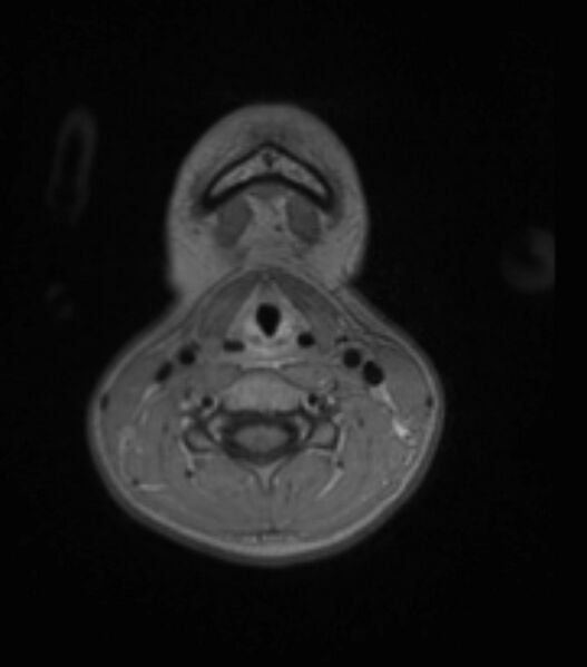 File:Choroid plexus carcinoma (Radiopaedia 91013-108553 Axial T1 C+ 11).jpg