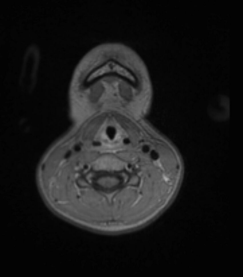 Choroid plexus carcinoma (Radiopaedia 91013-108553 Axial T1 C+ 11).jpg