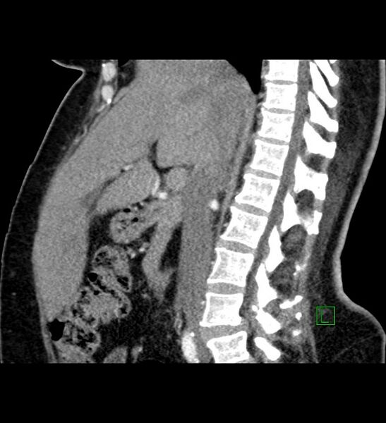File:Chromophobe renal cell carcinoma (Radiopaedia 84239-99519 D 67).jpg