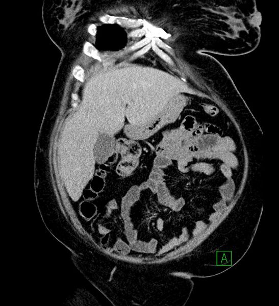 File:Chromophobe renal cell carcinoma (Radiopaedia 84239-99519 F 24).jpg