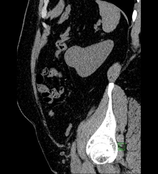 File:Chromophobe renal cell carcinoma (Radiopaedia 84286-99573 C 38).jpg