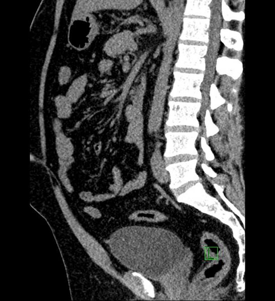 File:Chromophobe renal cell carcinoma (Radiopaedia 84286-99573 C 86).jpg