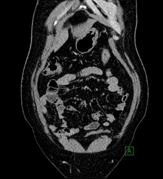 File:Chromophobe renal cell carcinoma (Radiopaedia 84286-99573 H 34).jpg