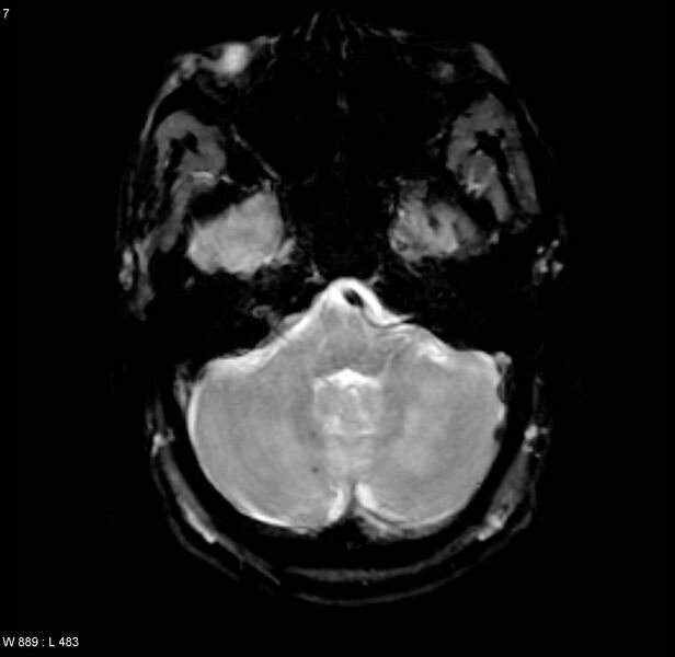 File:Chronic hypertensive encephalopathy (Radiopaedia 4564-6686 Axial Gradient Echo 2).jpg
