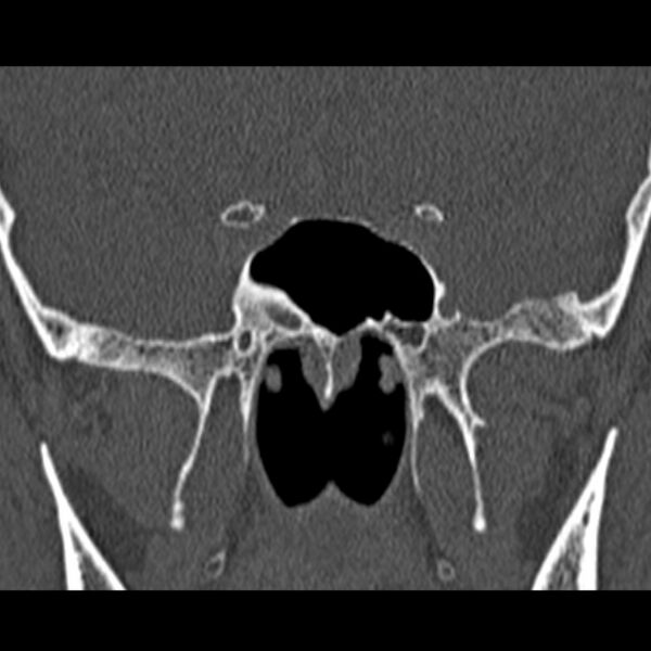 File:Chronic maxillary sinusitis (Radiopaedia 27879-28116 Coronal bone window 44).jpg