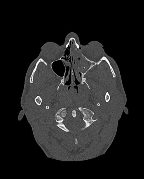 File:Chronic maxillary sinusitis caused by a foreign body (Radiopaedia 58521-65676 Axial bone window 156).jpg