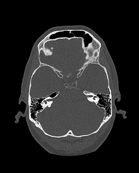 File:Chronic maxillary sinusitis caused by a foreign body (Radiopaedia 58521-65676 Axial bone window 261).jpg