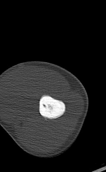 File:Chronic osteomyelitis of the distal humerus (Radiopaedia 78351-90971 Axial bone window 48).jpg