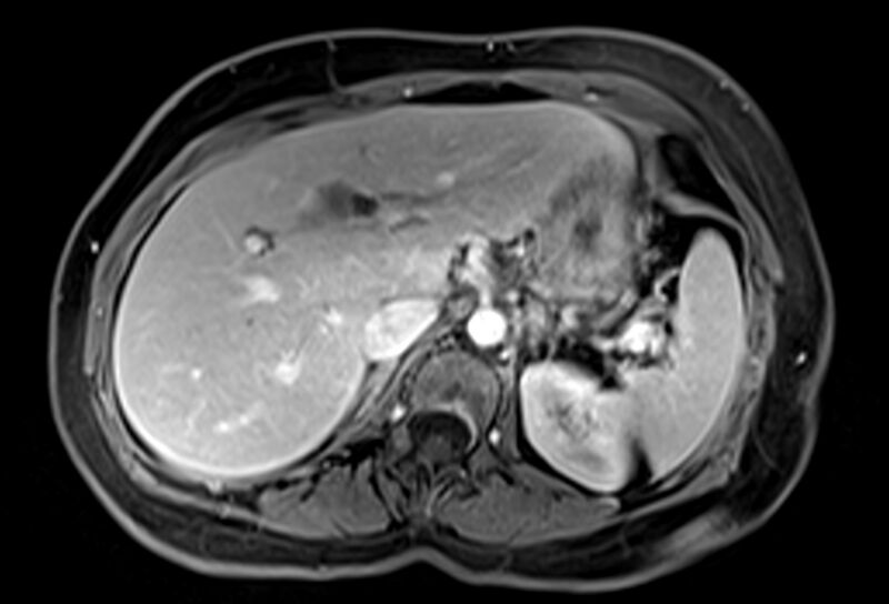 File:Chronic pancreatitis - pancreatic duct calculi (Radiopaedia 71818-82250 Axial T1 C+ fat sat 18).jpg