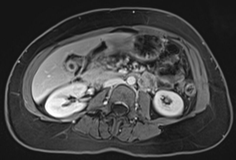 File:Chronic pancreatitis - pancreatic duct calculi (Radiopaedia 71818-82250 Axial T1 C+ fat sat 40).jpg