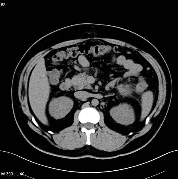 File:Chronic pancreatitis and pseudocysts (Radiopaedia 6724-7935 Axial non-contrast 11).jpg