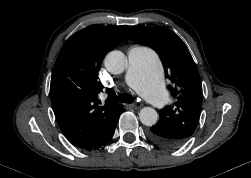 Chronic pulmonary embolism with bubbly consolidation (Radiopaedia 91248-108850 C+ arterial phase 55).jpg