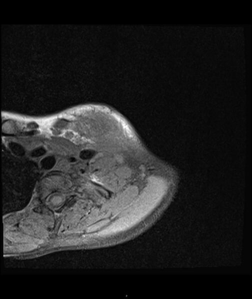 File:Chronic reactive multifocal osteomyelitis (CRMO) - clavicle (Radiopaedia 56406-63071 Axial T1 fat sat 5).jpg