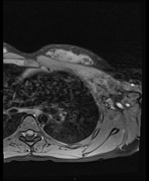 File:Chronic reactive multifocal osteomyelitis (CRMO) - clavicle (Radiopaedia 56406-63114 Axial T1 fat sat 22).jpg
