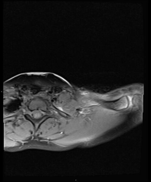 File:Chronic reactive multifocal osteomyelitis (CRMO) - clavicle (Radiopaedia 56406-63114 Axial T1 fat sat 7).jpg
