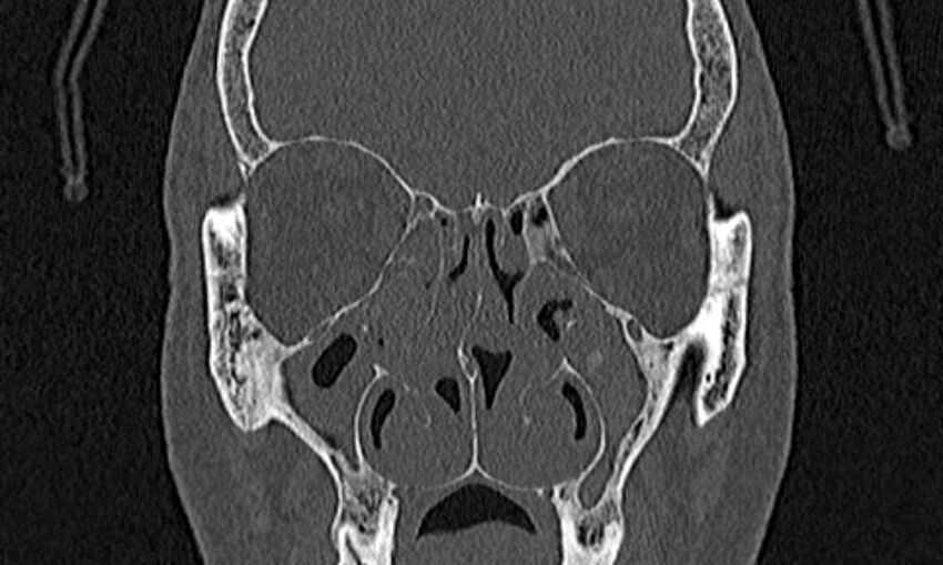 Chronic rhinosinusitis (Radiopaedia 65079-74075 Coronal bone window 36).jpg