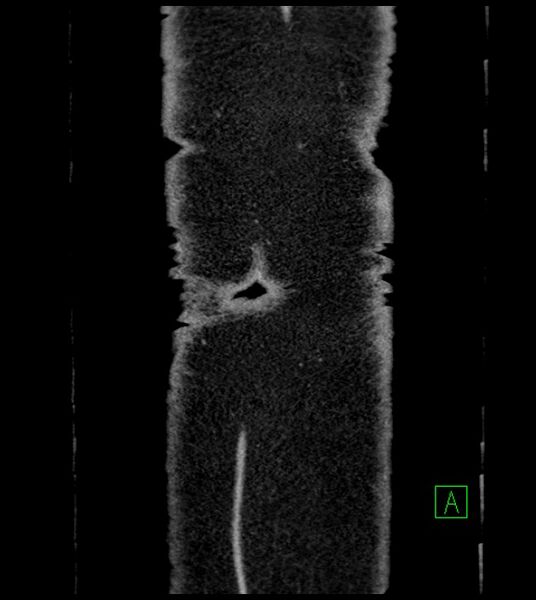 File:Closed-loop small bowel obstruction-internal hernia (Radiopaedia 78439-91096 Coronal non-contrast 105).jpg