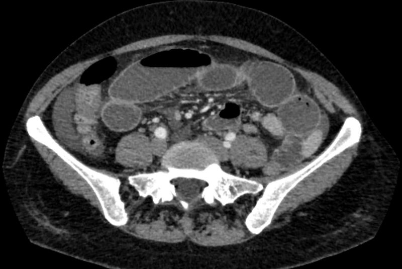 File:Closed loop small bowel obstruction (Radiopaedia 71211-81508 A 93).jpg